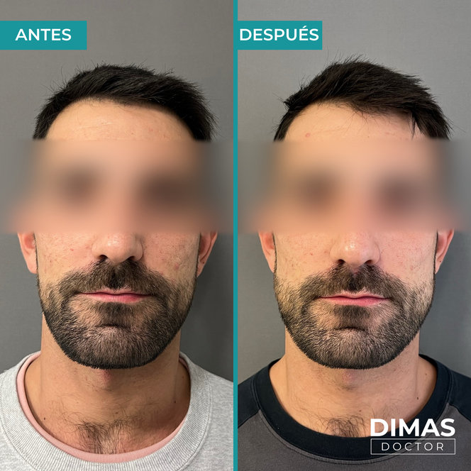Ácido hialurónico en mentón Barcelona – proyección y definición del contorno facial