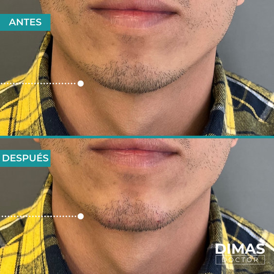 Relleno facial con ácido hialurónico en mentón – clínica en Barcelona